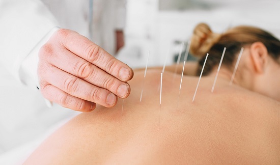 Benefits of acupuncture for anxiety 1